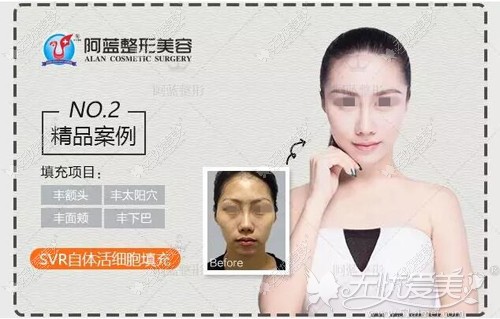 SVR自体活细胞填充案例