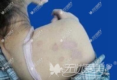 激光脱毛禁忌症