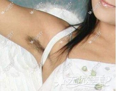 苏州激光脱毛医院