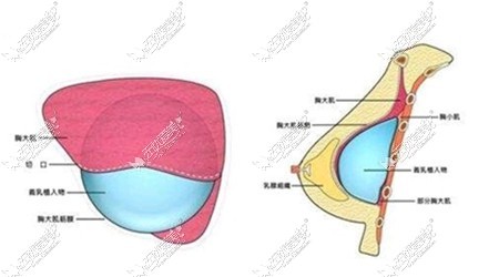 棉花糖丰胸手术腔隙剥离比较深