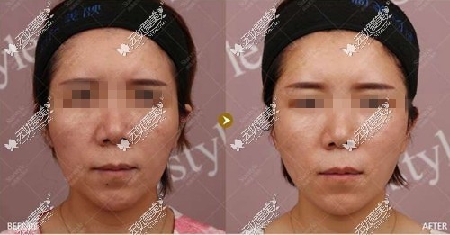 面部轻微下垂做埋线提升案例对比