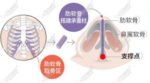 杨季涛做肋骨鼻技术原理
