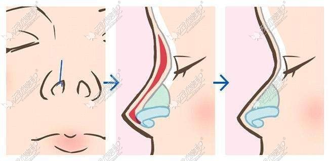 杨季涛隆鼻实例