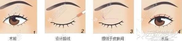 埋线双眼皮手术过程