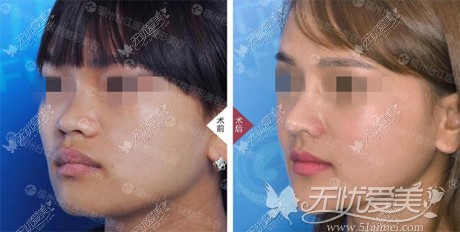 福州台江假体隆鼻对比案例