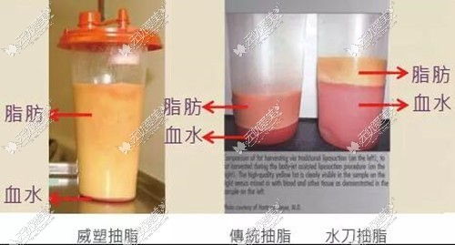 威塑吸出来的脂肪