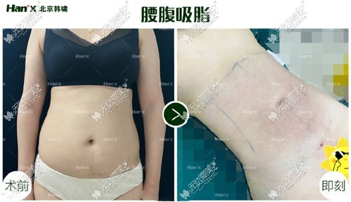 郑博晨医生腰腹吸脂对比图