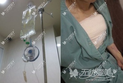 姜蓓蓓隆胸手术当天