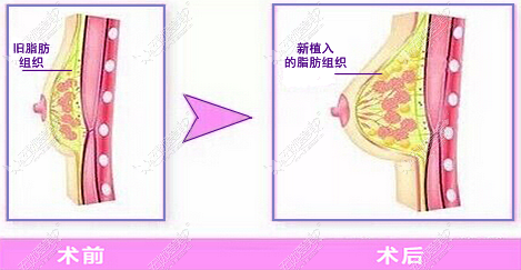 脂肪移植隆胸