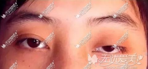 济南韩氏上睑下垂矫正