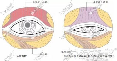 李承焕上睑提肌矫正