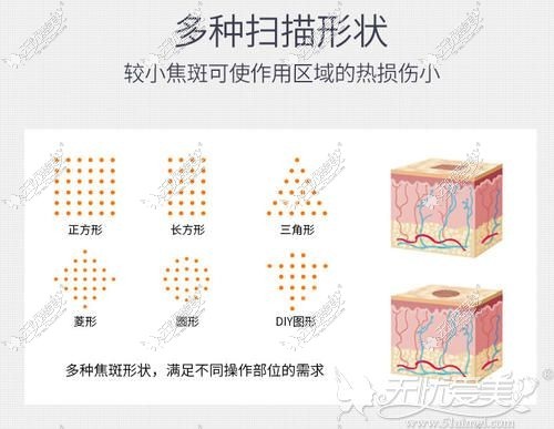 点阵激光的波段和扫描形状