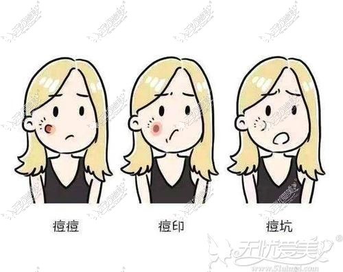 点阵激光去痘坑效果不错