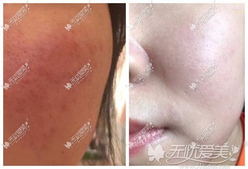 5次点阵激光图片