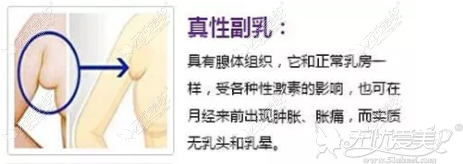真性副乳需要切除术来改善