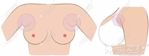常见的脂肪型副乳