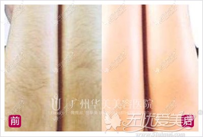 手部脱毛案例