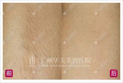 腿部冰点脱毛