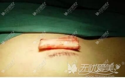 取软骨