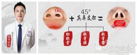 铜雀台半肋软骨隆鼻