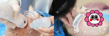 热玛吉的治疗过程