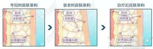 眼周热玛吉的治疗过程
