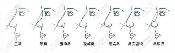 常见鼻型一览图