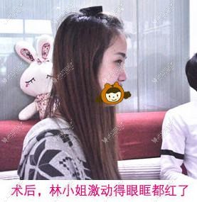 假体隆鼻术后的林小姐
