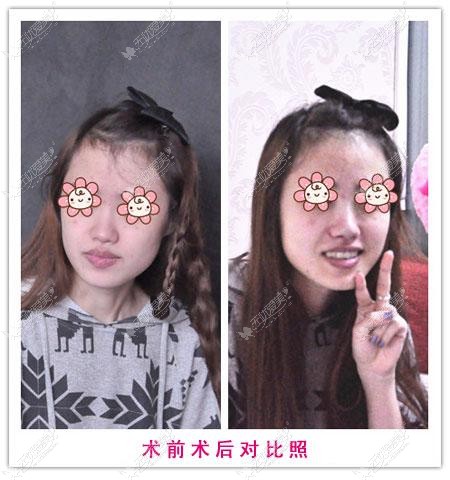 假体隆鼻术前术后对比照片
