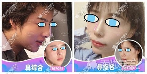 北京悦然李京霖隆鼻案例