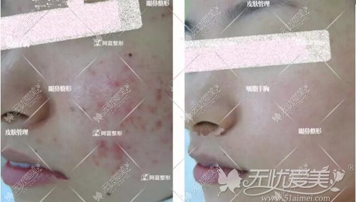 激光去痘印前后对比案例