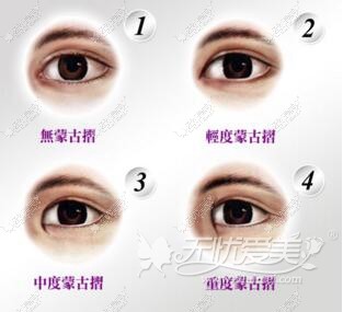 蒙古眼的特征