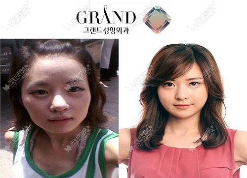 “V线条下颌角手术”每个医院有什么不一样?