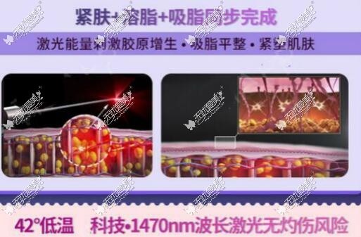 5g天使光雕吸脂操作原理