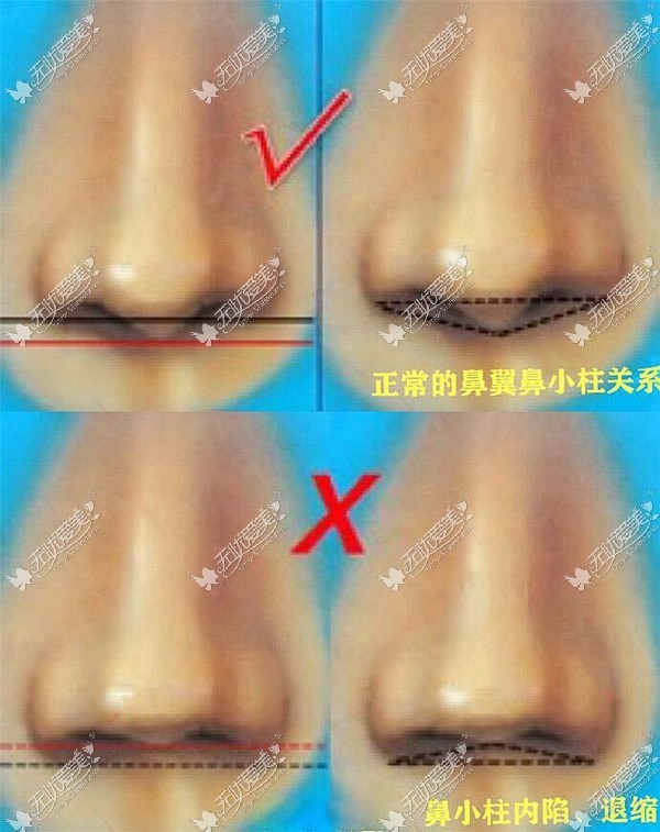 李劲良做鼻小柱修复怎么样？
