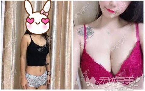 韩国普罗菲耳整形蓓拉假体隆胸真人案例