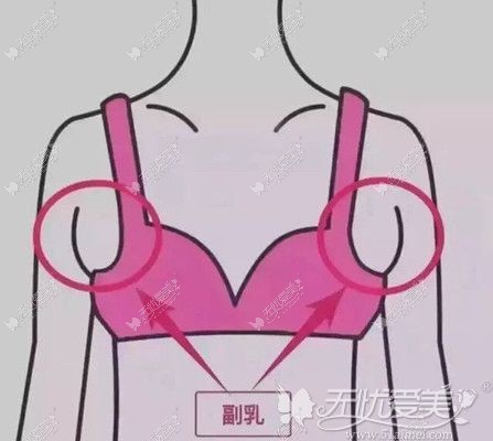 副乳是一般在腋下出现的多余的脂肪