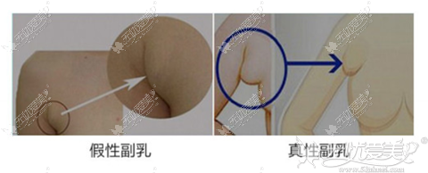 真性副乳和假性副乳的区别