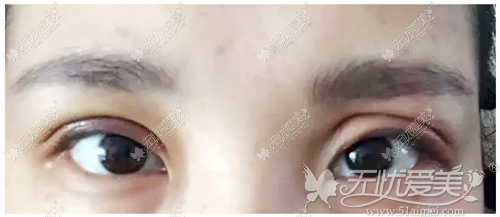 做的埋线双眼皮手术后肉条感明显