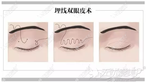 埋线双眼皮手术过程
