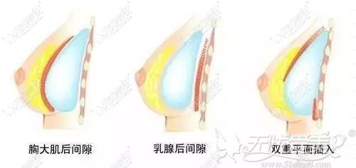 假体隆胸和脂肪丰胸的层次不同