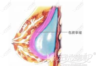 假体包膜挛缩不能同时做脂肪填充