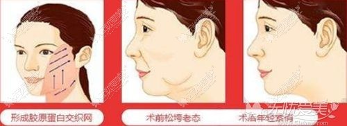 30-40岁做埋线提升可以改善面部下垂