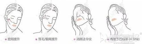 40岁以后做埋线提升可以改善面部轮廓