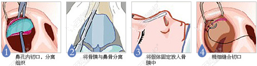 韩式隆鼻过程