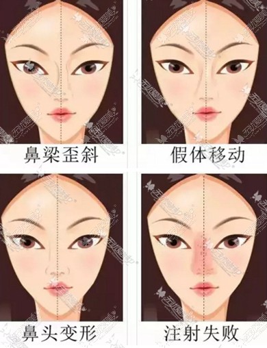 鼻整形失败类型