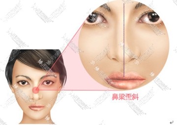 鼻梁歪斜
