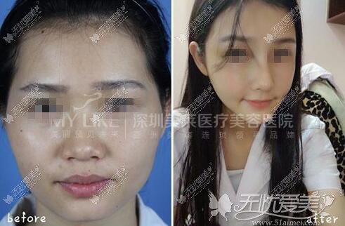深圳美莱面部脂肪填充前后对比案例