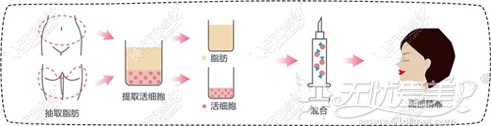 面部脂肪填充原理