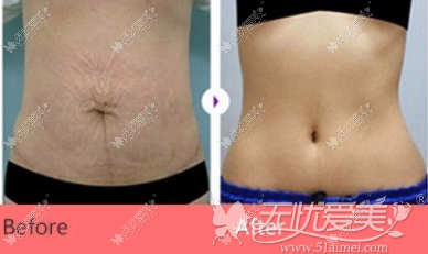 佛山金子腰腹吸脂手术案例
